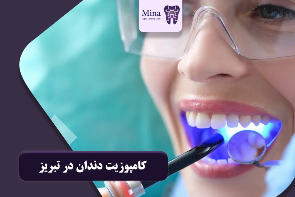 کامپوزیت دندان در تبریز
