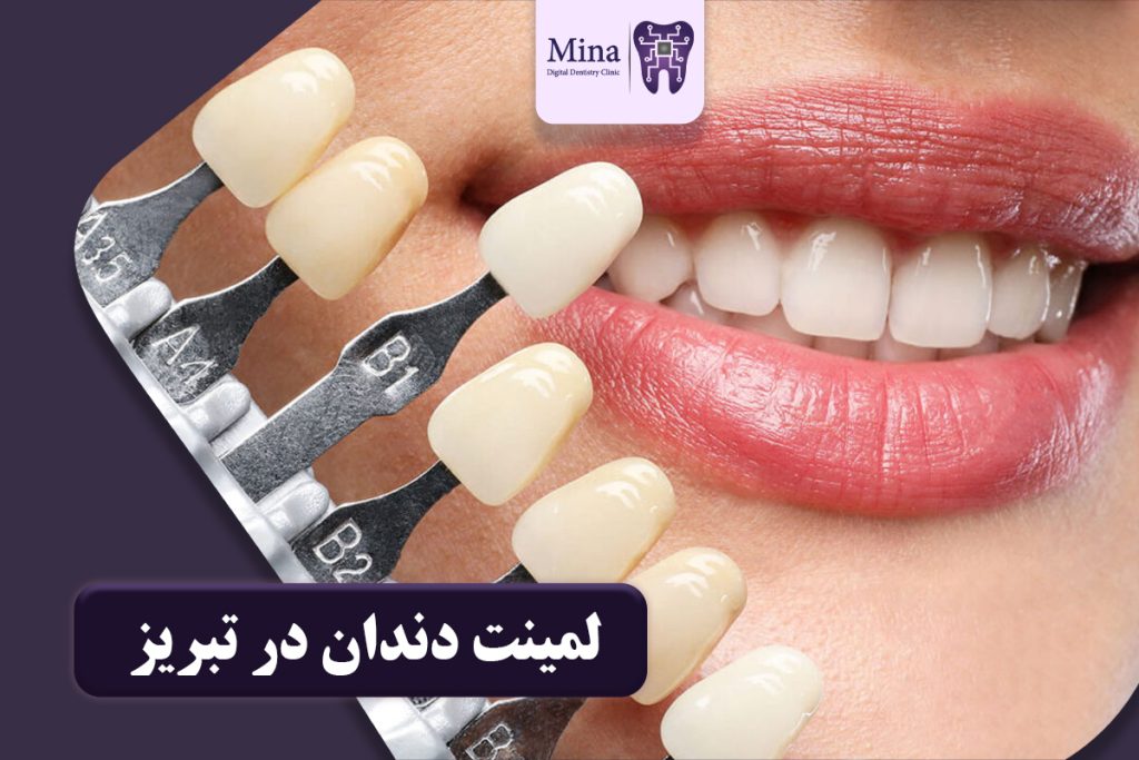 لمینت دندان در تبریز