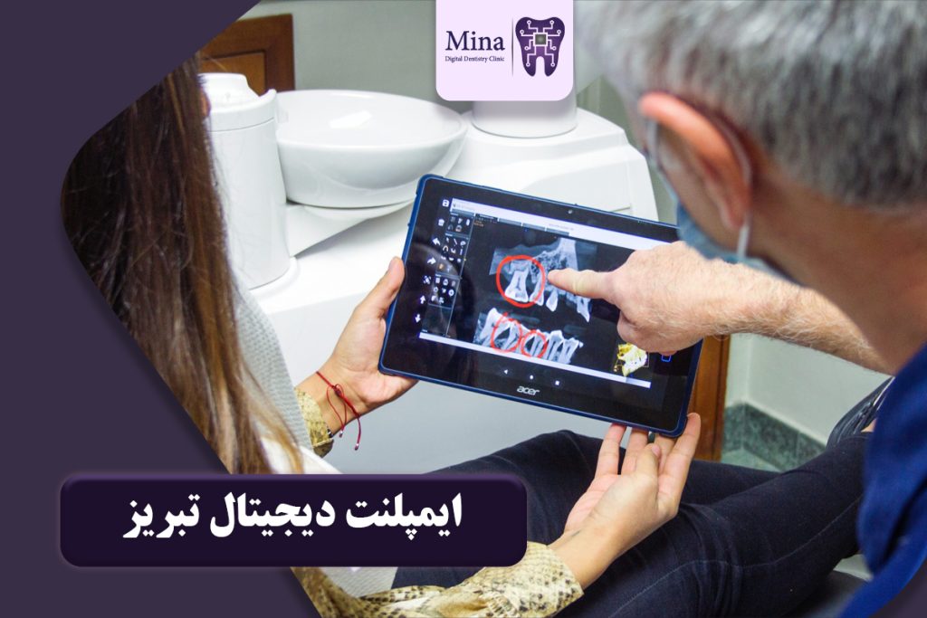 ایمپلنت دیجیتال تبریز