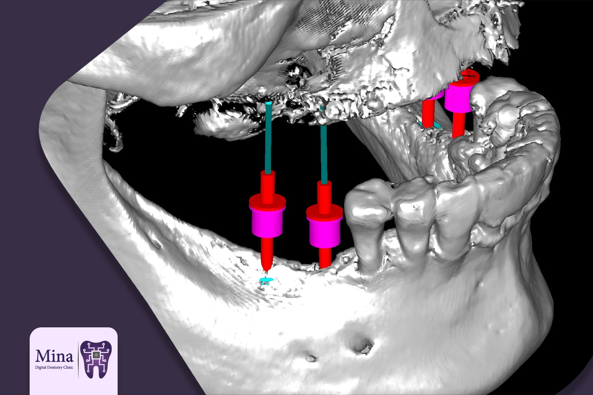 Methods to reduce pain and discomfort in dental implants in Tabriz