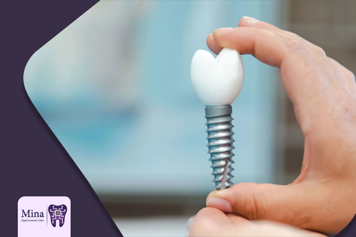 قیمت ایمپلنت بدون درد در تبریز 