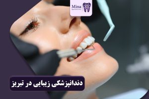 دندانپزشکی زیبایی در تبریز