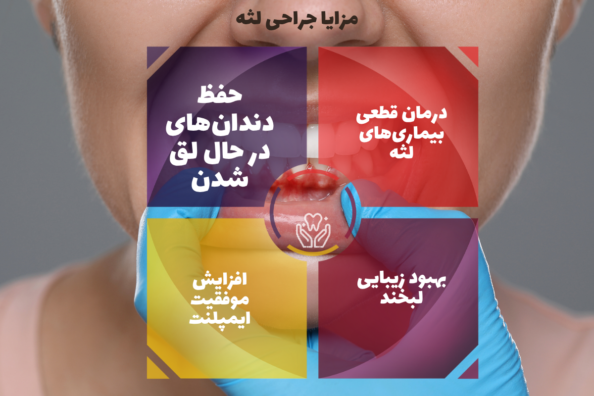 مزایا جراحی لثه 