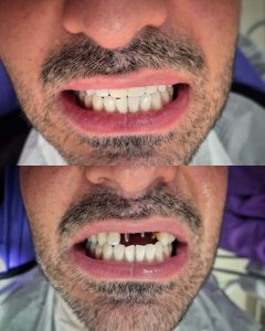 نمونه درمان ایمپلنت دندان در تبریز