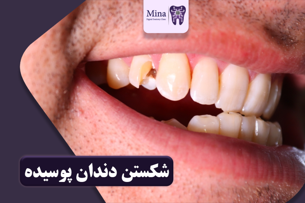 شکستن دندان پوسیده