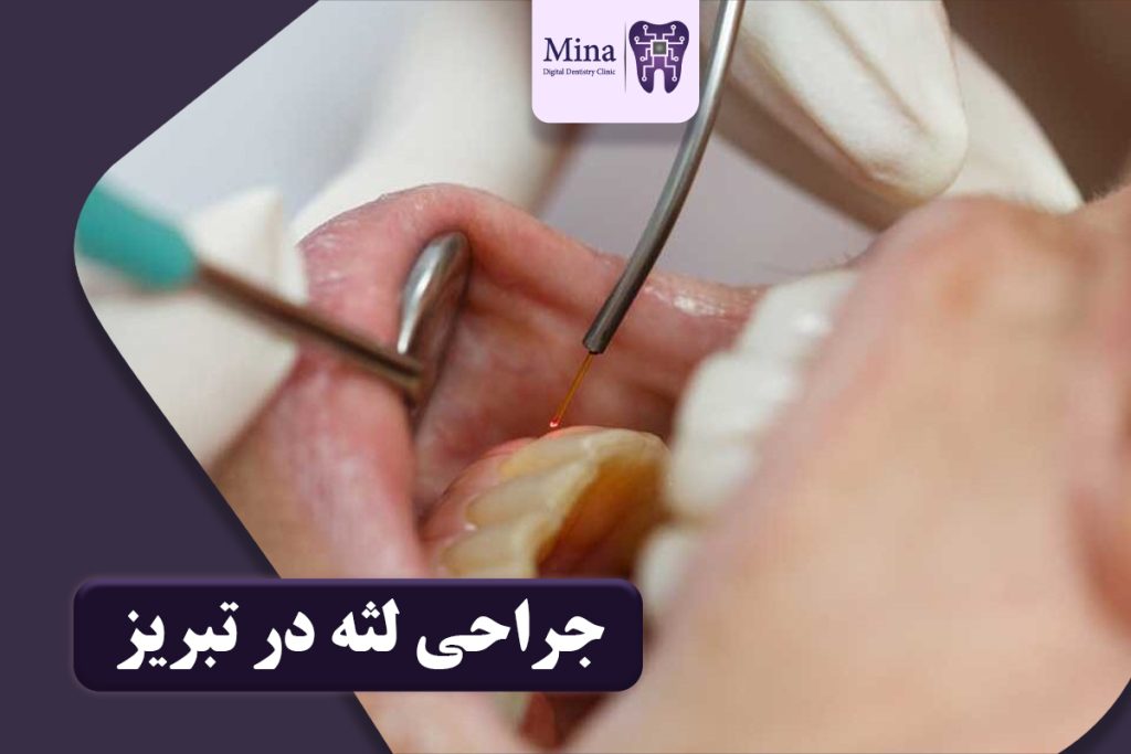 متخصص جراحی لثه در تبریز