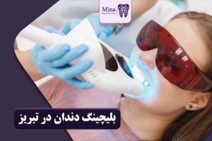 بلیچینگ دندان در تبریز