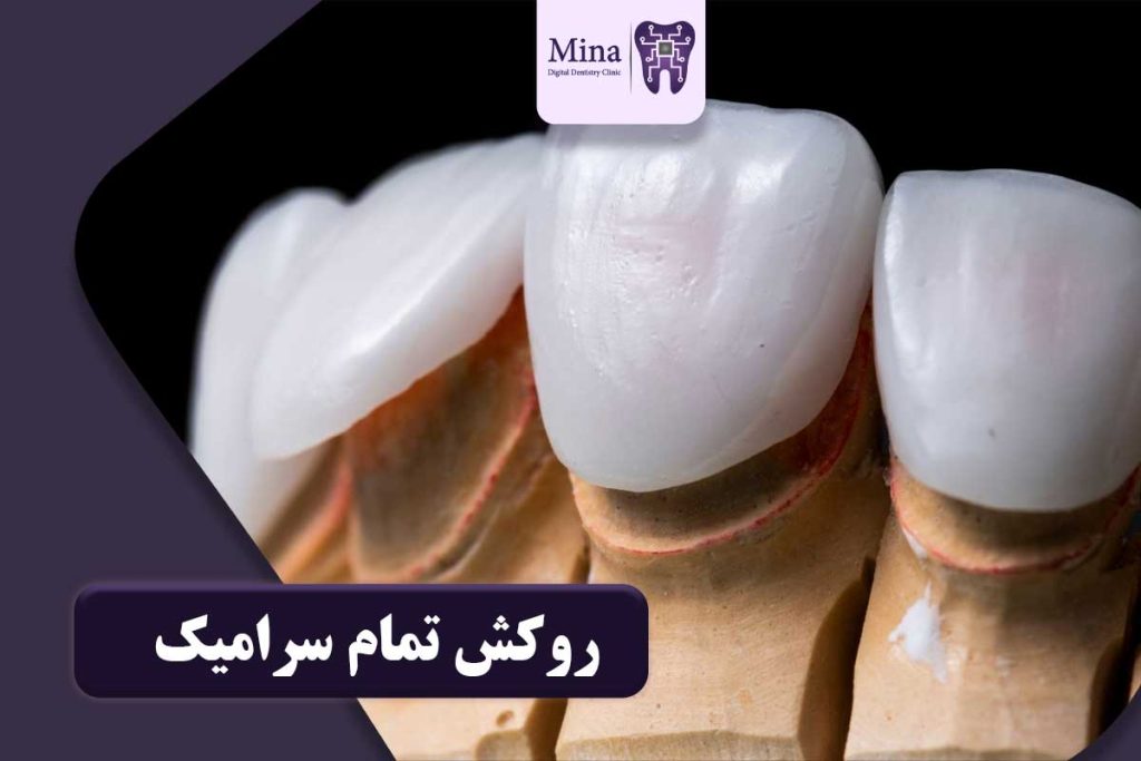 روکش تمام سرامیک