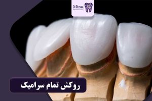 روکش تمام سرامیک