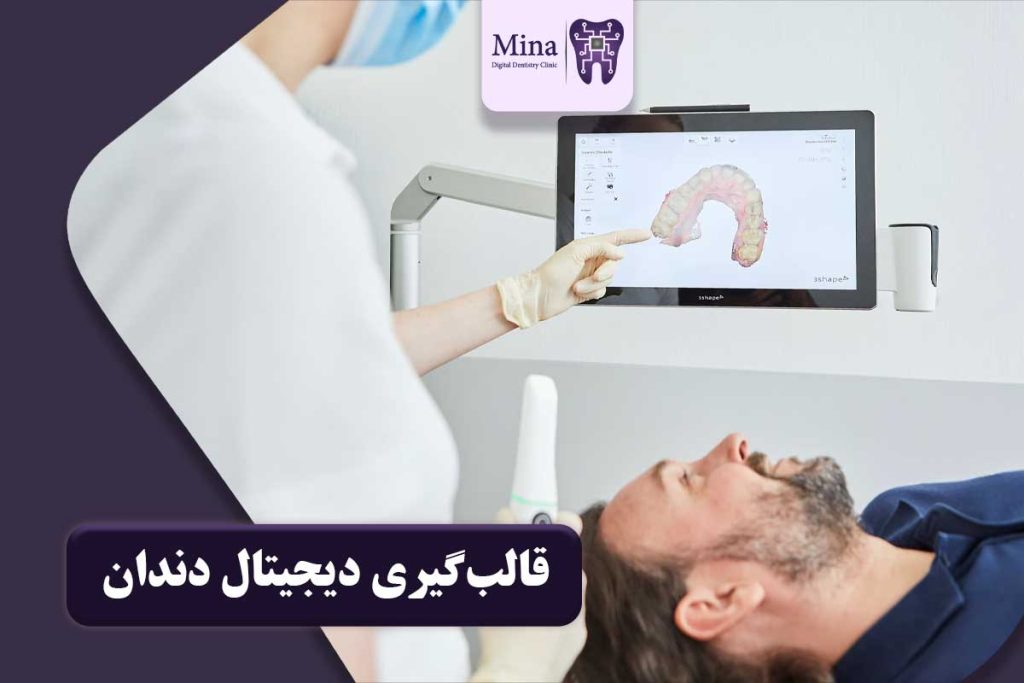 قالب گیری دیجیتال دندان