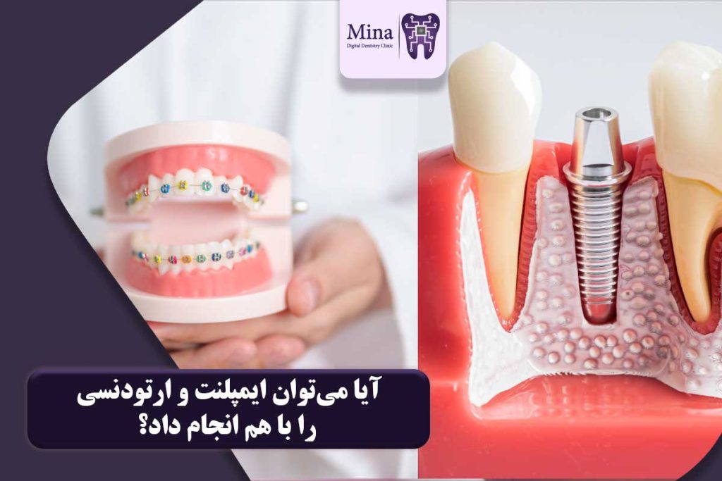 ایمپلنت و ارتودنسی