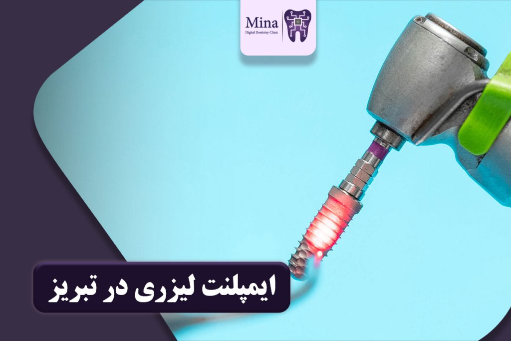ایمپلنت لیزری در تبریز