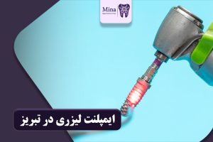 ایمپلنت لیزری در تبریز