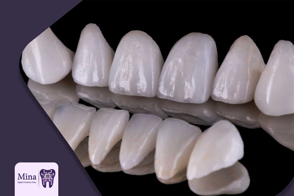 طول عمر روکش تمام سرامیک
