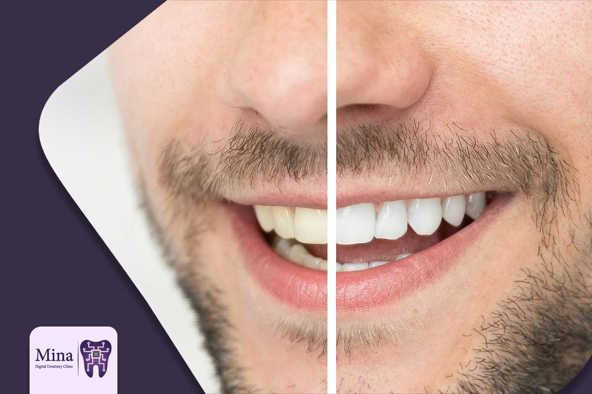 کلینیک دندان‌پزشکی مینا برای سفید کردن دندان