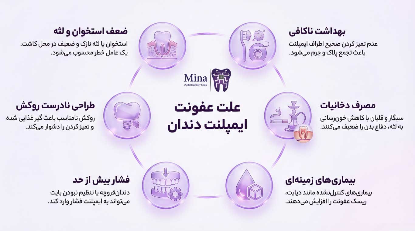 علت عفونت ایمپلنت دندان