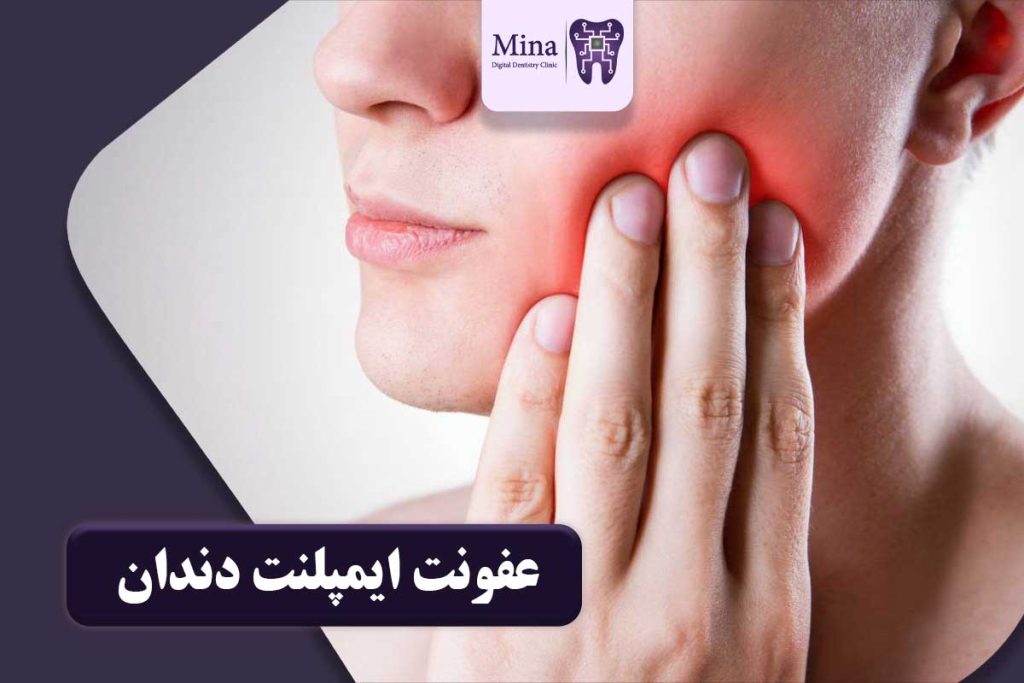 عفونت ایمپلنت دندان