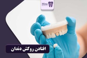 افتادن روکش دندان