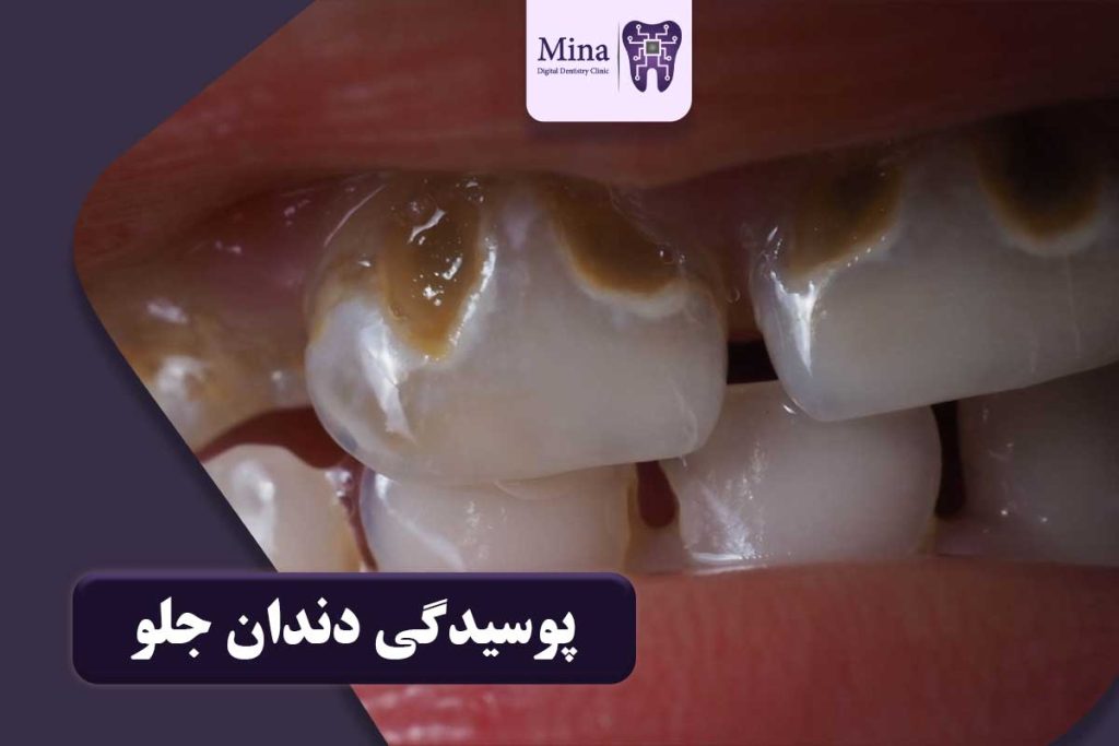 پوسیدگی دندان جلو