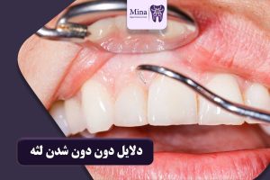 دون دون شدن لثه