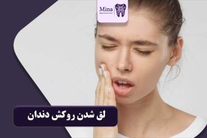 لق شدن روکش دندان