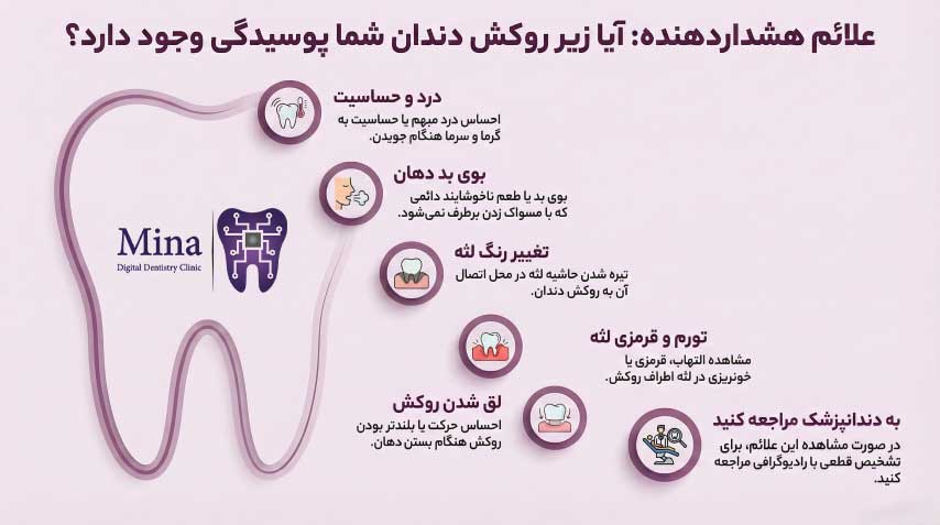 علائم پوسیدگی زیر روکش دندان