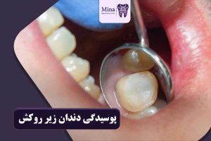 پوسیدگی دندان زیر روکش