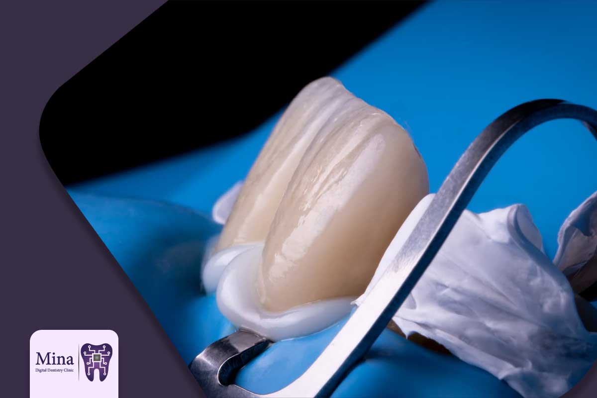 انواع چسب دندانپزشکی