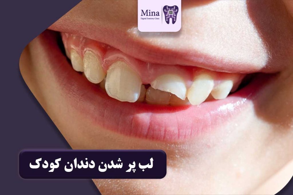 لب پر شدن دندان کودک