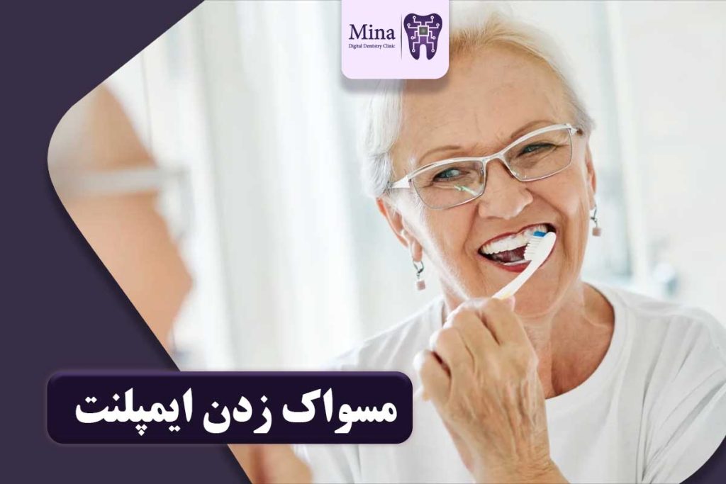 مسواک زدن ایمپلنت