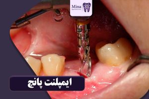 پانچ ایمپلنت دندان