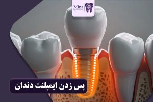 حساسیت و پس زدن ایمپلنت دندان