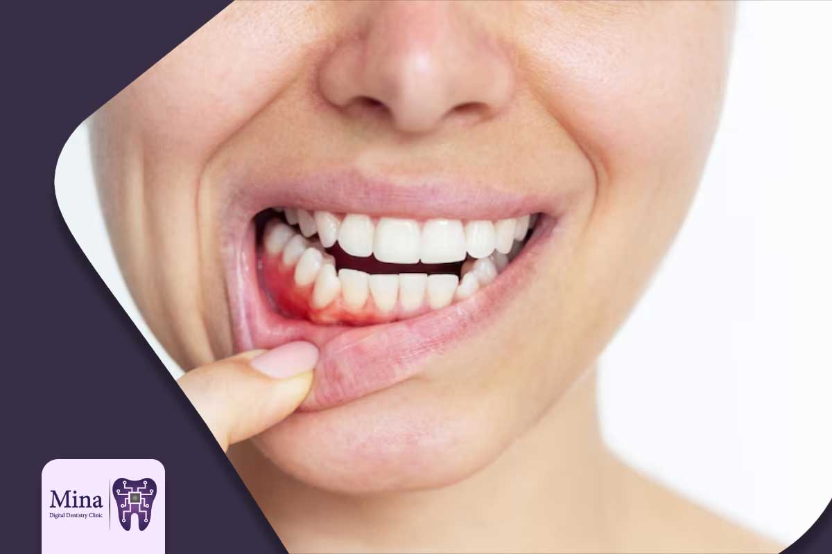 تشخیص جوش سفید روی لثه