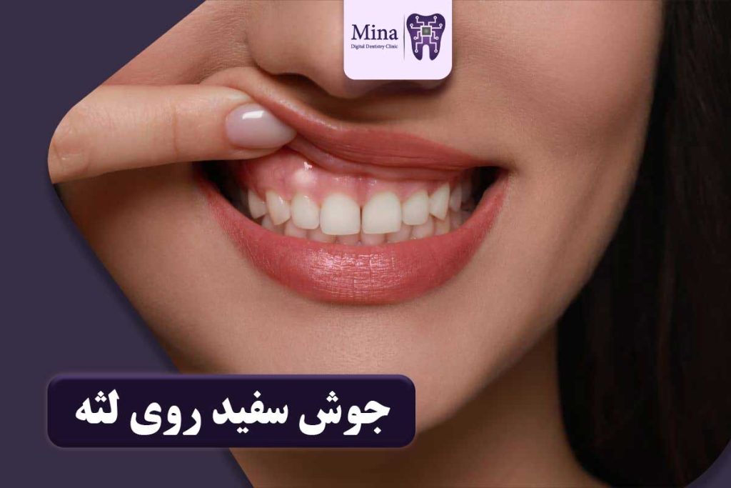 جوش سفید روی لثه