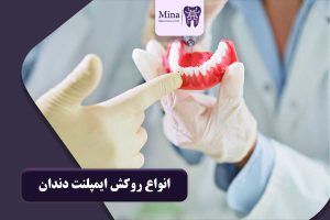 روکش ایمپلنت دندان
