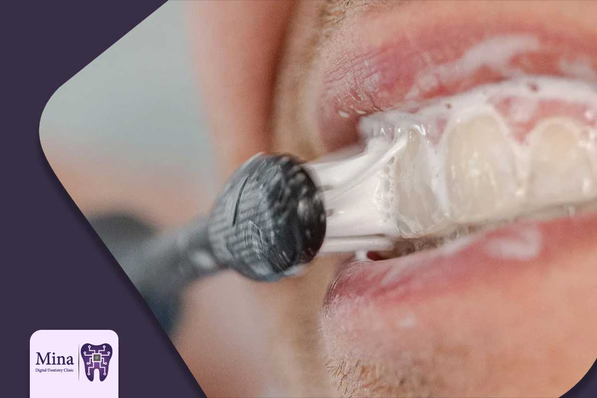 مراقبت‌های ویژه: استفاده از مسواک برقی برای افراد دارای ایمپلنت و لمینت