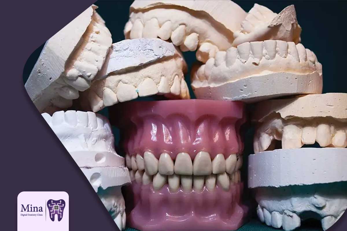 پروتز دندان بر پایه ایمپلنت چیست و چه تفاوتی دارد؟