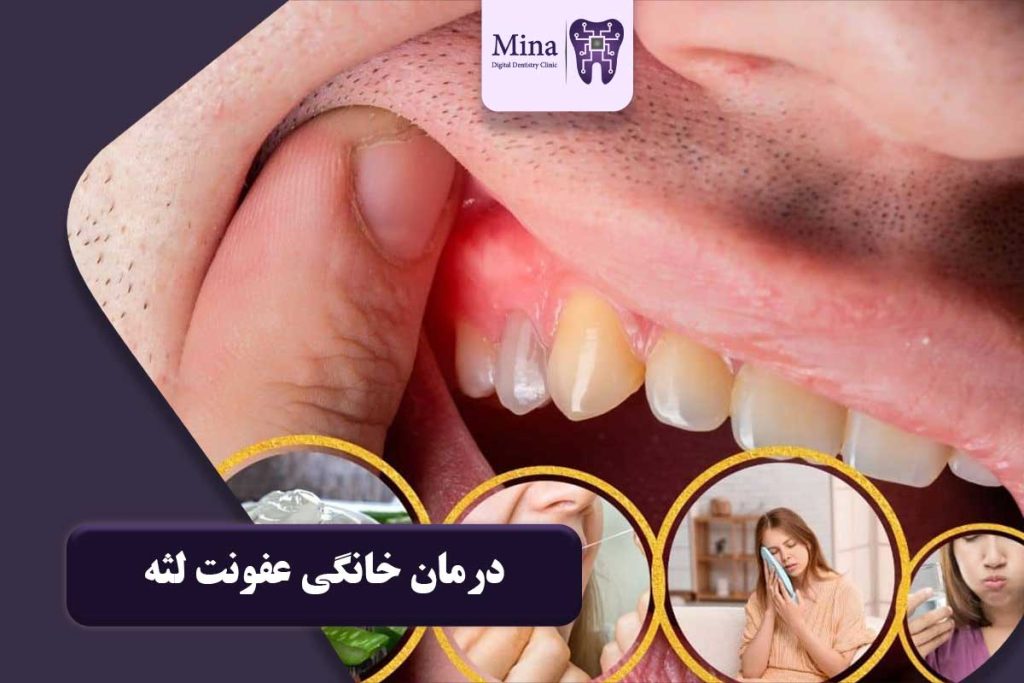 درمان خانگی عفونت لثه