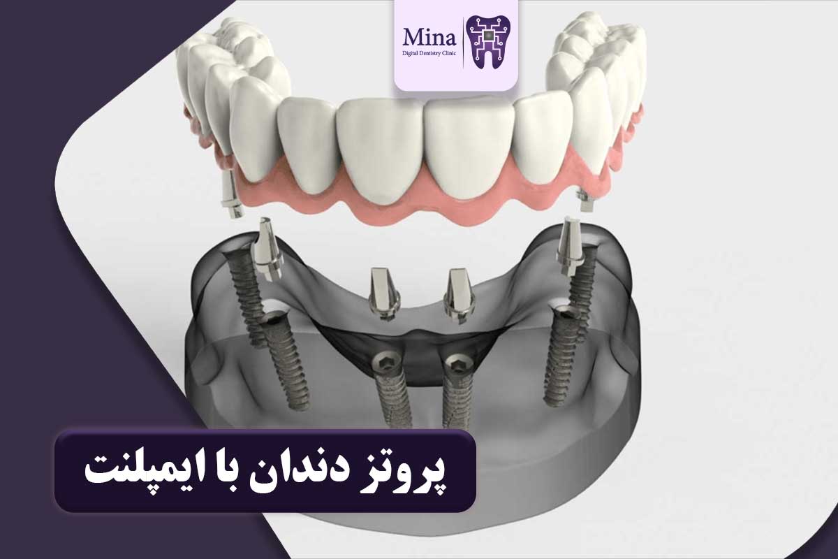 پروتز دندان با ایمپلنت