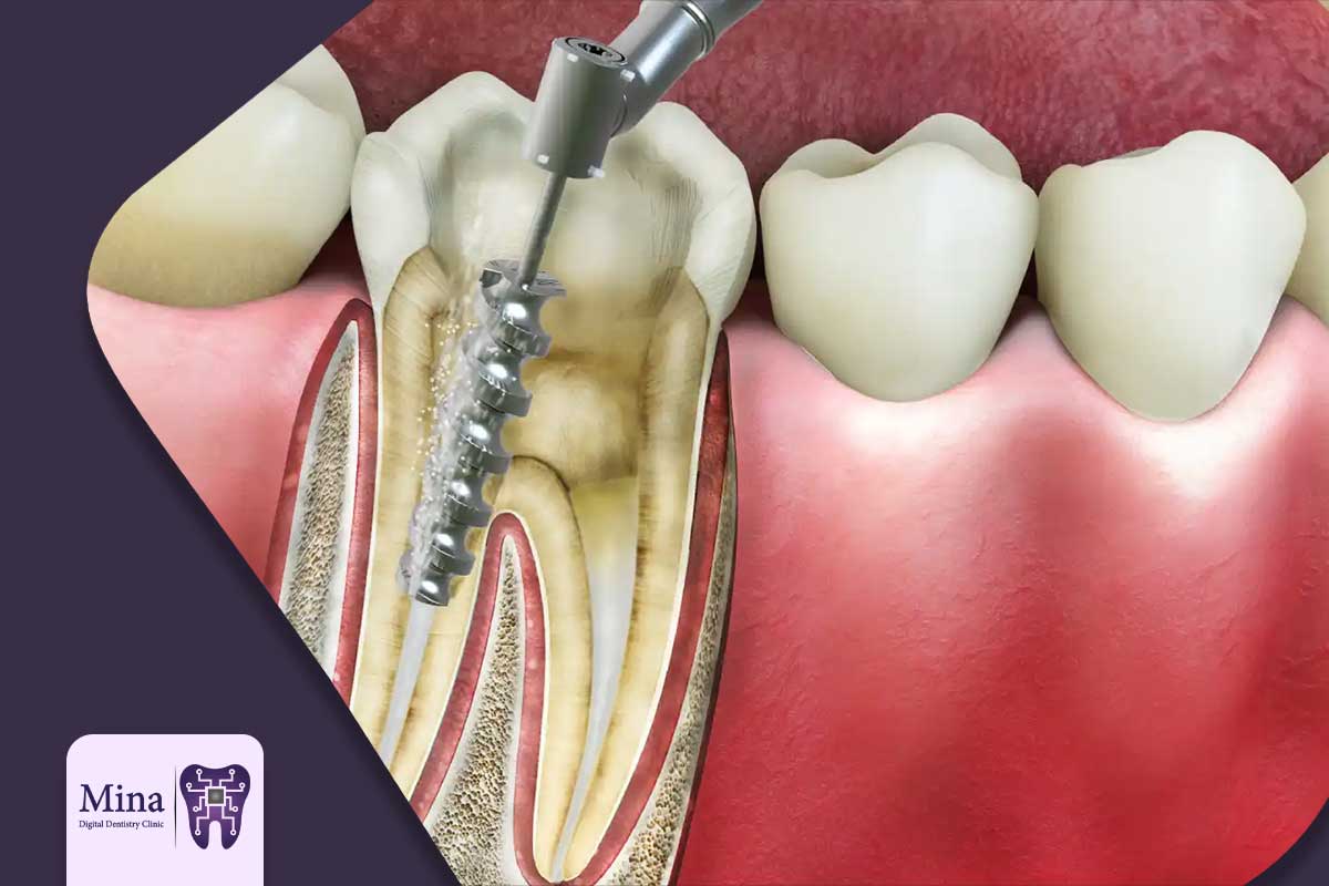 عصب کشی دندان در تبریز