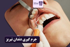 جرم گیری دندان در تبریز