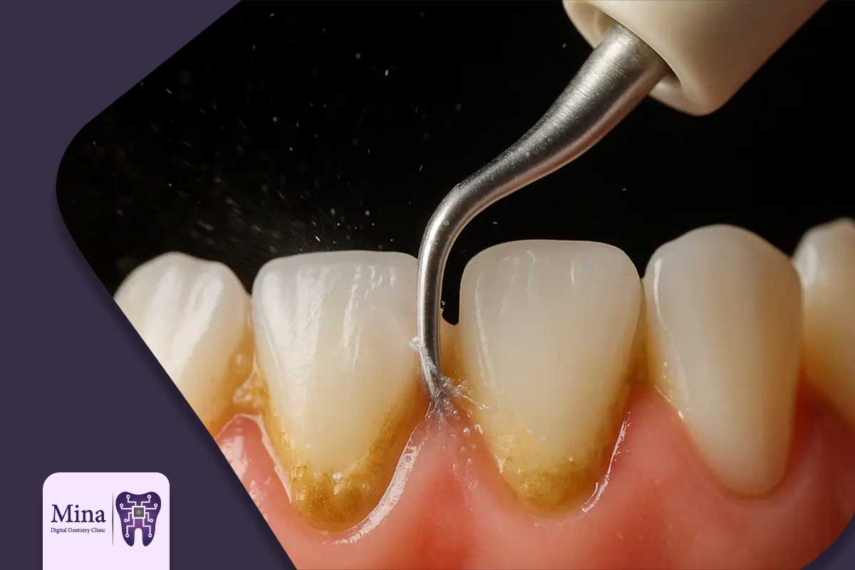 جرم گیری دندان در تبریز