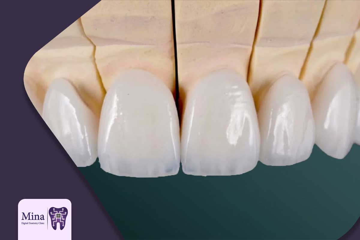 آیا لمینت دندان دائمی است