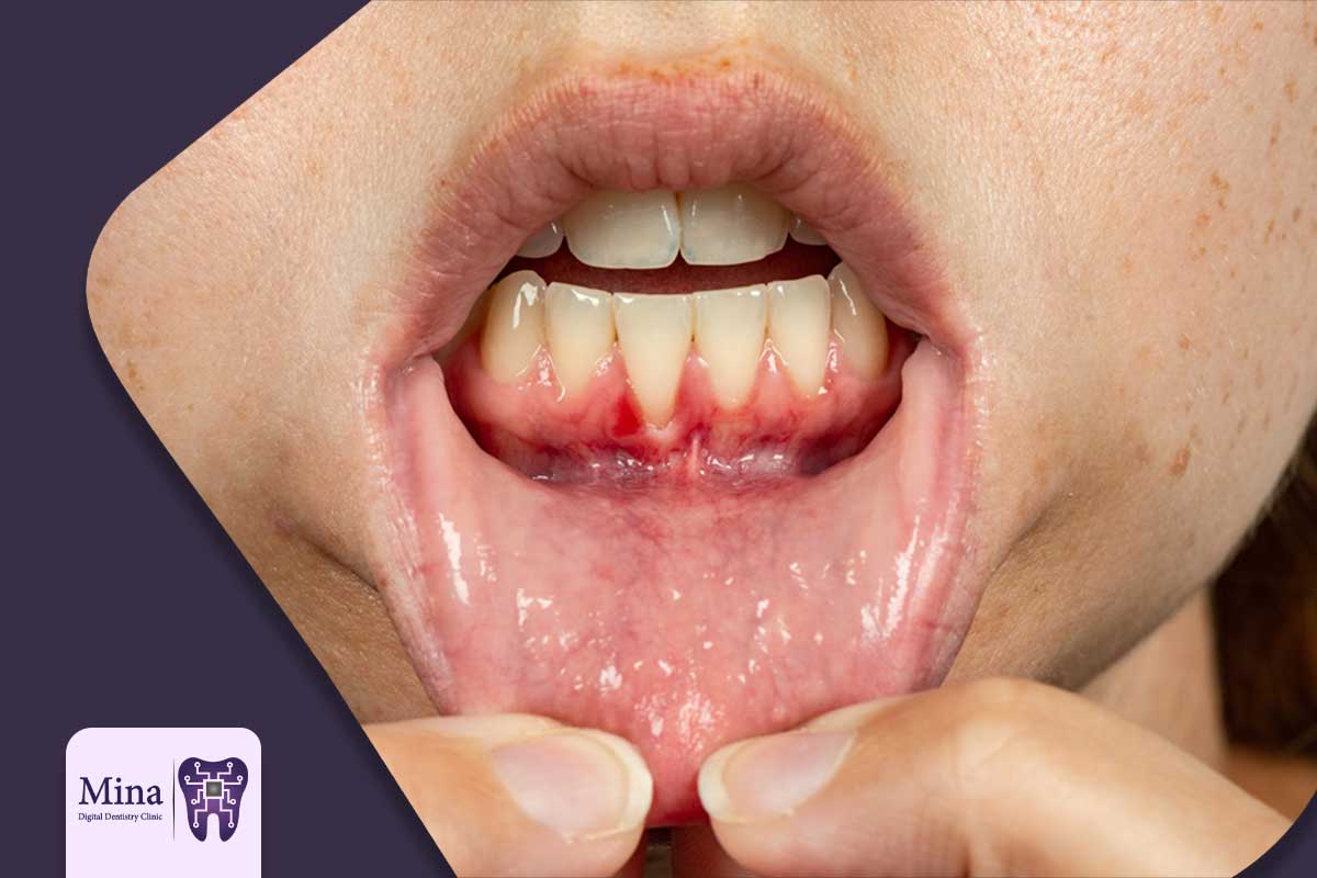 چرا عفونت لثه (پریودنتال) دشمن اصلی دندان‌ها و بزرگترین مانع ایمپلنت است؟