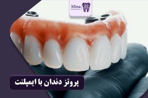 پروتز دندان با ایمپلنت