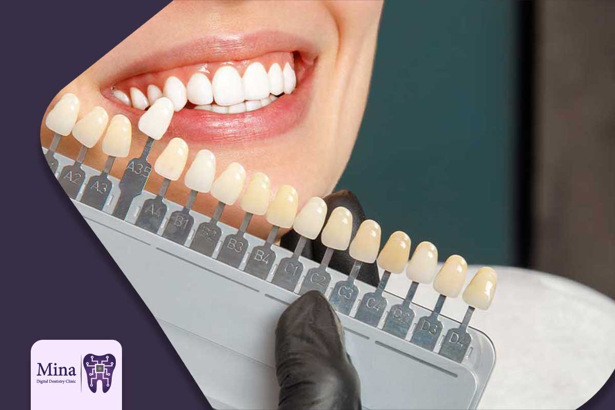 تجربه لمینت خانم رسولی پس از ۱۲ سال