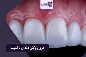 فرق روکش دندان با لمینت
