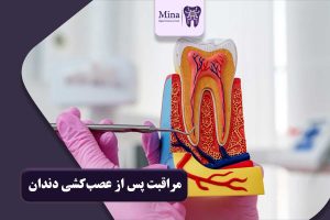 مراقبت پس از عصب‌کشی دندان