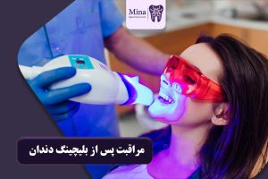 مراقبت پس از بلیچینگ دندان