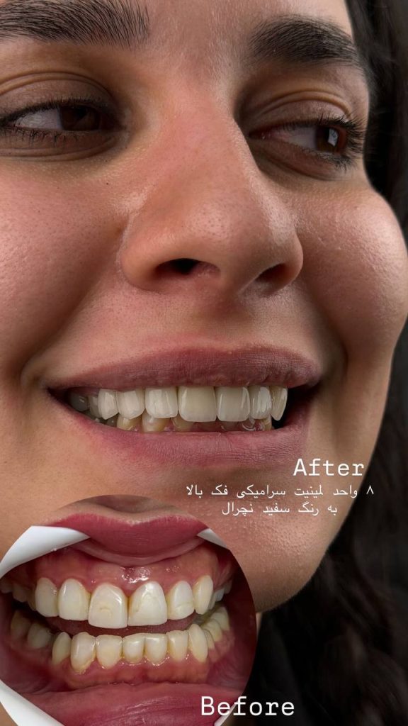 تصویر قبل و بعد بیمار لمینت دندان در تبریز